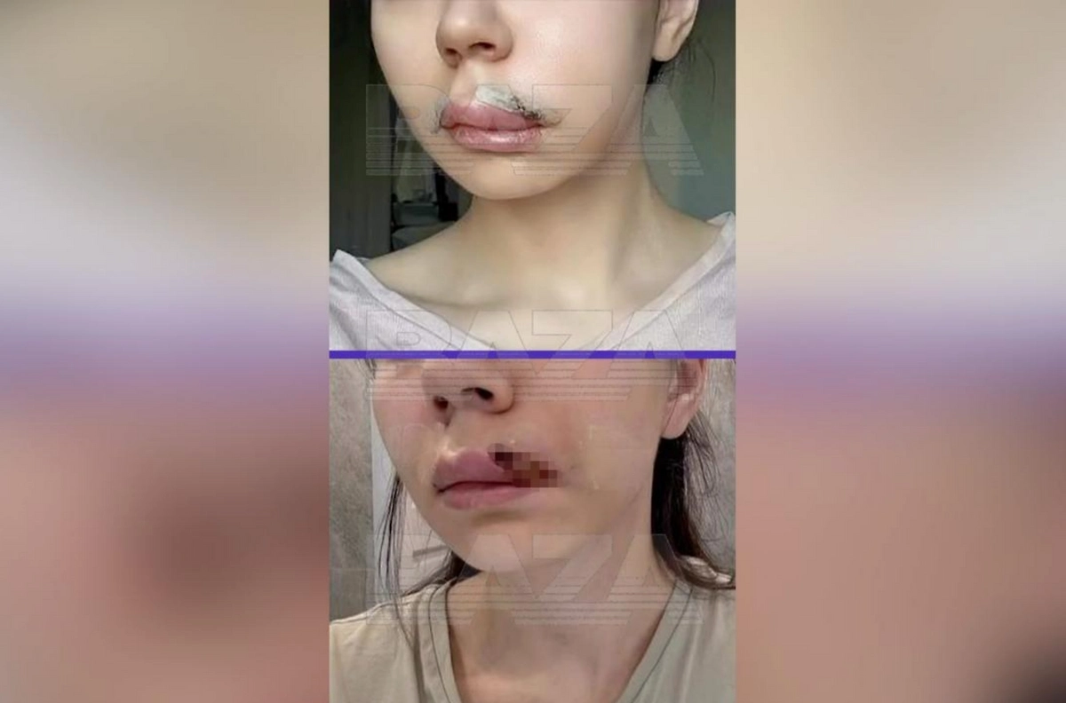 Жительница Казани едва не лишилась губы после неудачной хейлопластики. Фото © Baza