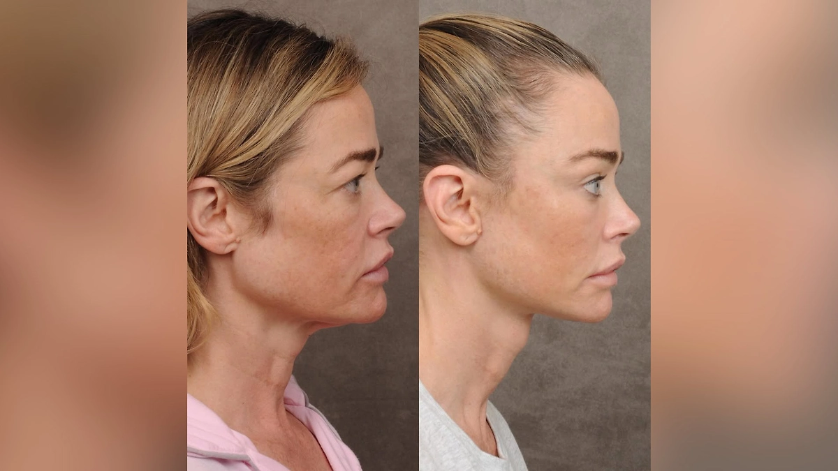 Дениз Ричардс рассказала о самой болезненной операции. Фото © Instagram (признан экстремистской организацией и запрещён на территории Российской Федерации) / deniserichards