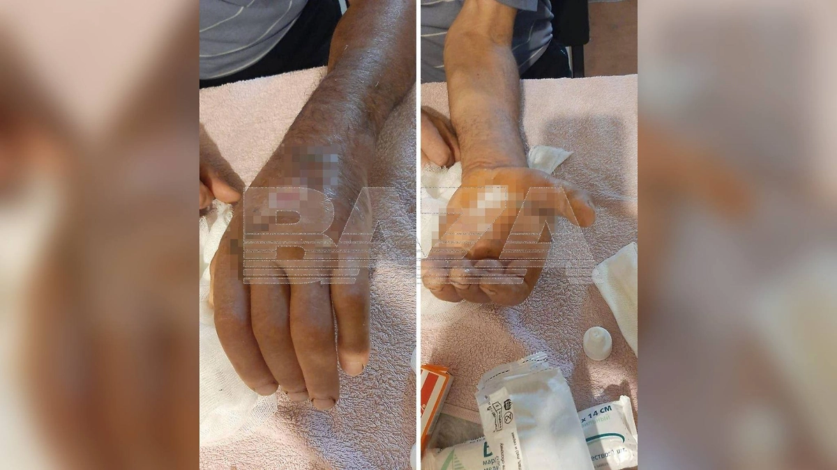 Конь укусил мужчину за руку и заразил его инфекцией в Белгородской области. Фото © Telegram / Baza