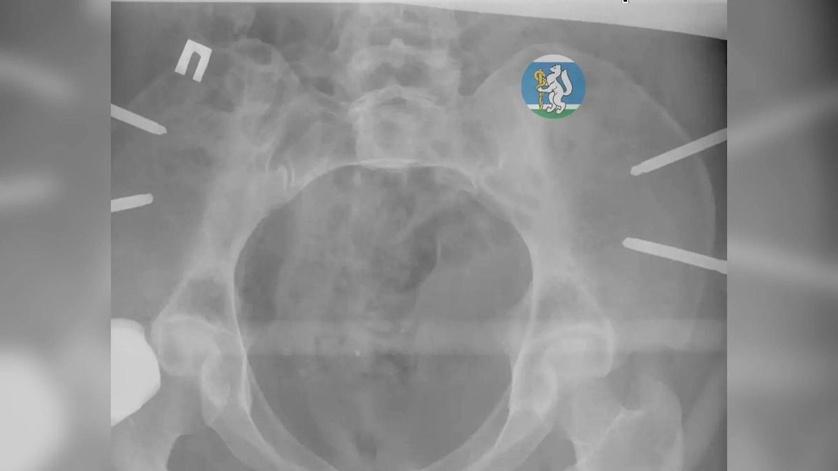 В Екатеринбурге врачи спасли женщину после падения с седьмого этажа. Фото © Telegram / Здоровье уральцев