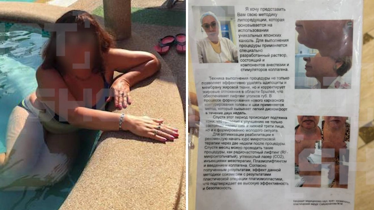 В Москве пациентка умерла после анестезии во время подготовки к липосакции. Фото © Telegram / SHOT