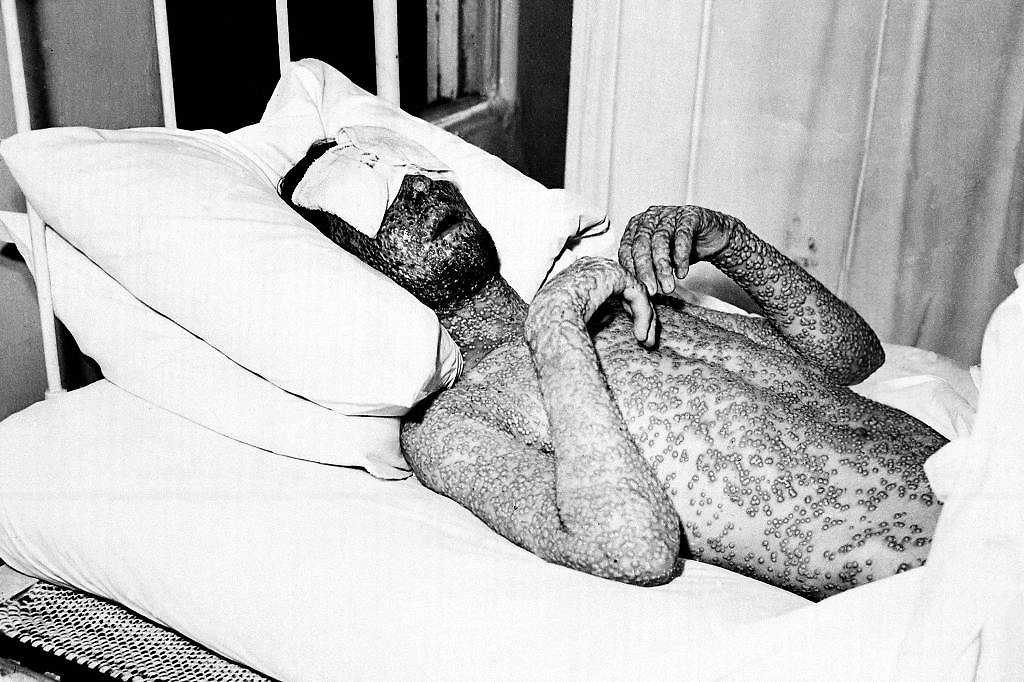 Как лечили чёрную оспу в СССР: КГБ против вируса в 1959 году. Фото © ТАСС / ASSOCIATED PRESS