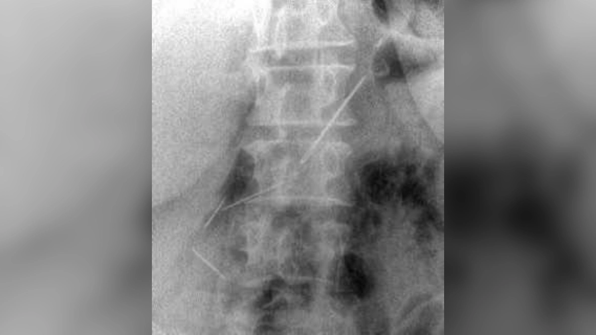 Женщину, проглотившую четыре швейные иглы спасли в Красногорске. Фото © пресс-служба Минздрава Московской области 