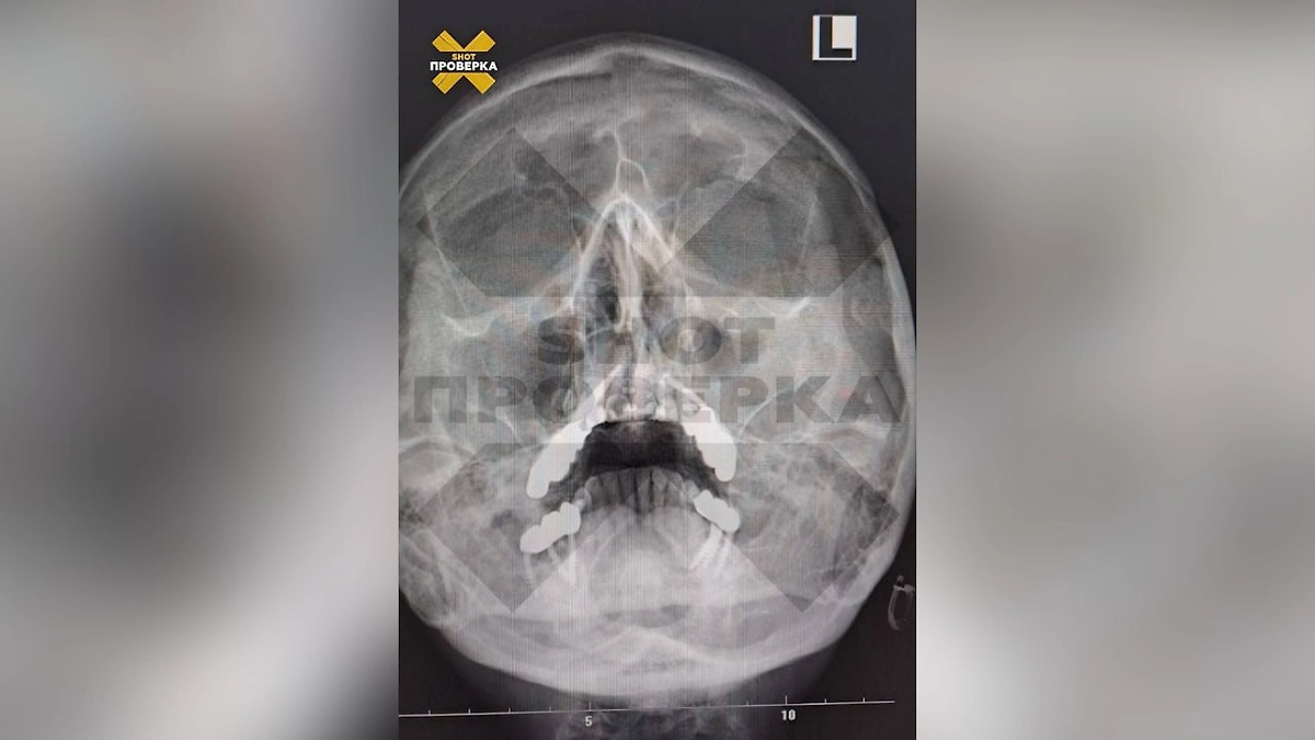 У клиентки «поехала» челюсть после установки импланта. Видео © Telegram / SHOT ПРОВЕРКА