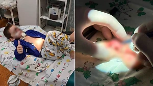 В Краснодаре хирурги восстановили лицо мальчика, которое целиком откусила собака