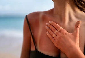 Врач объяснил, что происходит с телом при ожогах после загара