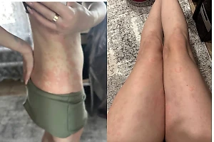 Россиянка покрылась волдырями, пытаясь бросить курить. Под подозрением пастилки "Никоретте"