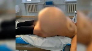 "Это не фотошоп": Жительница Башкирии вырастила в матке 30-литровую опухоль яичника