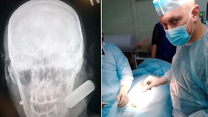 "Все назад!": Хирург выгнал всех из операционной, опасаясь, что боеприпас в черепе бойца может рвануть