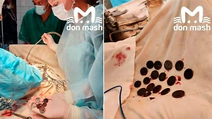 Ростовский хирург достала из желудка пациента 26 монет, проглоченных в раннем детстве