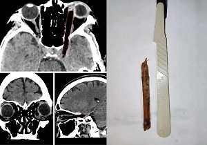 Россиянка две недели ходила с 8-сантиметровой веткой в черепе и осталась без глаза