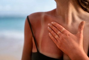 Врач объяснил, что происходит с телом при ожогах после загара