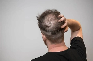 Мужчинам назвали четыре способа замедлить облысение