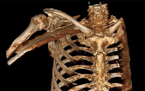 Пронзён, но не сломлен: Врачи спасли россиянина с куском арматуры, торчащим из-пoд мышки