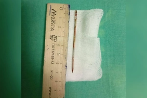 Врачи извлекли швейную иглу из уретры любопытного школьника