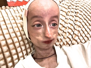 Девочку «эльфа» из Новосибирска отказались оперировать из-за редкой болезни
