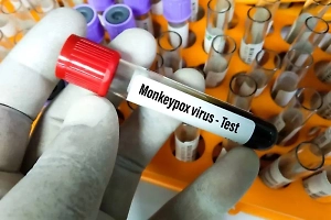 В Роспотребнадзоре оценили риск распространения нового штамма оспы обезьян в РФ