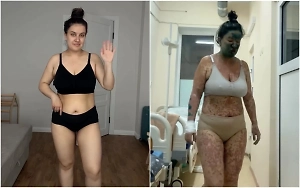 Жуткие язвы и сыпь покрыли тело российской блогерши после приёма парацетамола и ибупрофена