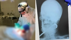 В Липецке врачи спасли 82-летнего пенсионера, удалив из его горла метровую арматуру