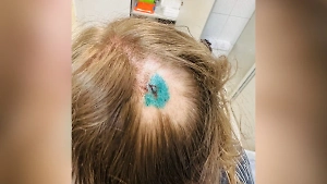 Сотрясение и плешь: Безумная чайка пробила клювом туристке голову на Сахалине