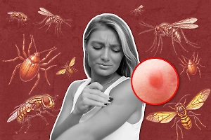 Как отличать укусы разных насекомых, какие самые опасные и как спастись в сезон охоты на людей
