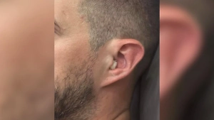 Россиянин искупался в речке и оглох из-за заражения смертельной бактерией