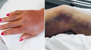 Укусила гадюка? Врачи показали последствия нападения ползучих монстров