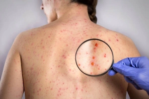 Ситуация чрезвычайная: В Россию спустя 10 лет вернулся опасный для беременных вирус