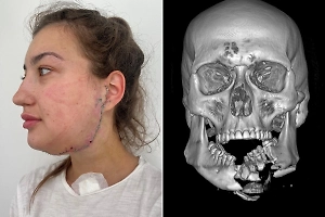 Российские врачи вернули девушке лицо, пробитое трубой во время ДТП