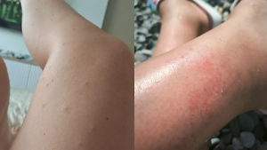 Российские туристы столкнулись с необычной аллергией на популярных курортах