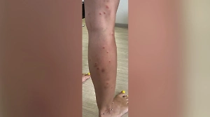 Россиян в Китае атакуют блохи, вызывающие паразитарные болезни