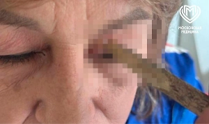 Московские врачи помогли женщине с застрявшей веткой в глазу