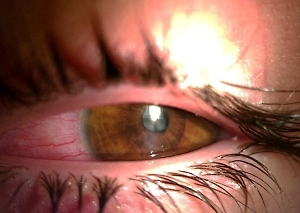 Российский подросток чуть не ослеп из-за каштана