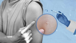 Почему его нет у зумеров: Как по шраму от БЦЖ на плече узнать соотечественника в любой точке мира