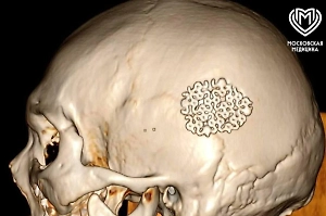 «Шанс был один из тысячи»: Нейрохирурги в Москве вернули к жизни мужчину с тяжёлой травмой мозга