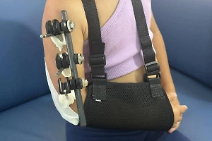 Подмосковные врачи спасли руку 10-летней девочке после многочисленных переломов