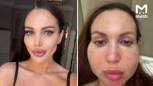 Вколола четыре препарата за раз: Косметолог без диплома превратила лицо россиянки в грушу