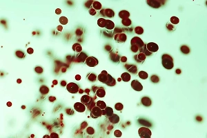 Тревожные звоночки: Гематолог назвал первые признаки, по которым можно заподозрить лейкоз