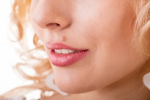 Тревожные признаки: Косметолог рассказала, в каких случаях необходимо удалять выпуклые родинки