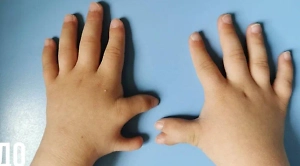 Врачи отрезали палец 5-летнему Мише. Но он был не против, ведь родился с полидактилией