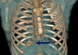 Фейерверк взорвался в груди подростка в Иркутске