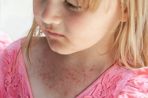 Роспотребнадзор выпустил заявление о массовой вспышке вируса Коксаки