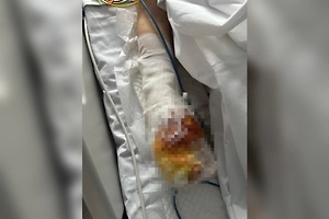 Подорвавшегося на мине-ловушке мальчика держат под наркозом из-за сильных болей