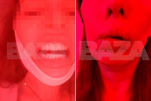 Не может есть и говорить: Россиянку изуродовали в частной стоматологии за 2 млн рублей