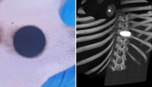 Сюрприз в желудке: У четырёхлетней россиянки во время операции на сердце нашли большую монету