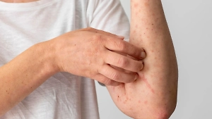 Врач объяснила, чем опасен «рецидив» ветрянки