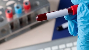 Российские учёные научились определять деменцию на ранних стадиях по крови