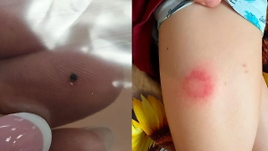 Кровопийцы под кожей: Отпуск российских туристов в Таиланде стал адом из-за нашествия клещей