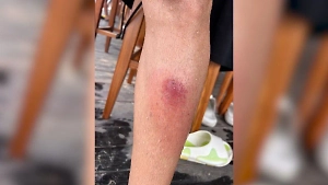 «Лопались капилляры»: Десятки российских туристов подхватили смертельно опасную инфекцию на Бали