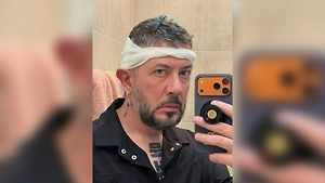 «Пусть будет густо там, где видно»: Артемий Лебедев иронично отчитался о пересадке волос